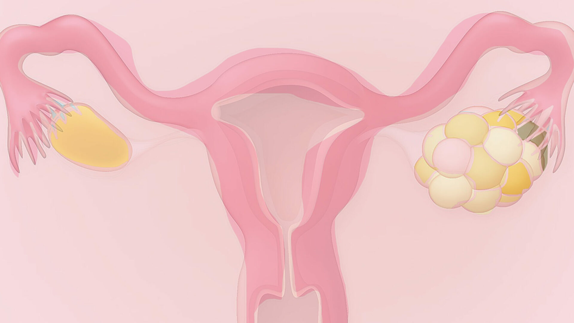 PCOS