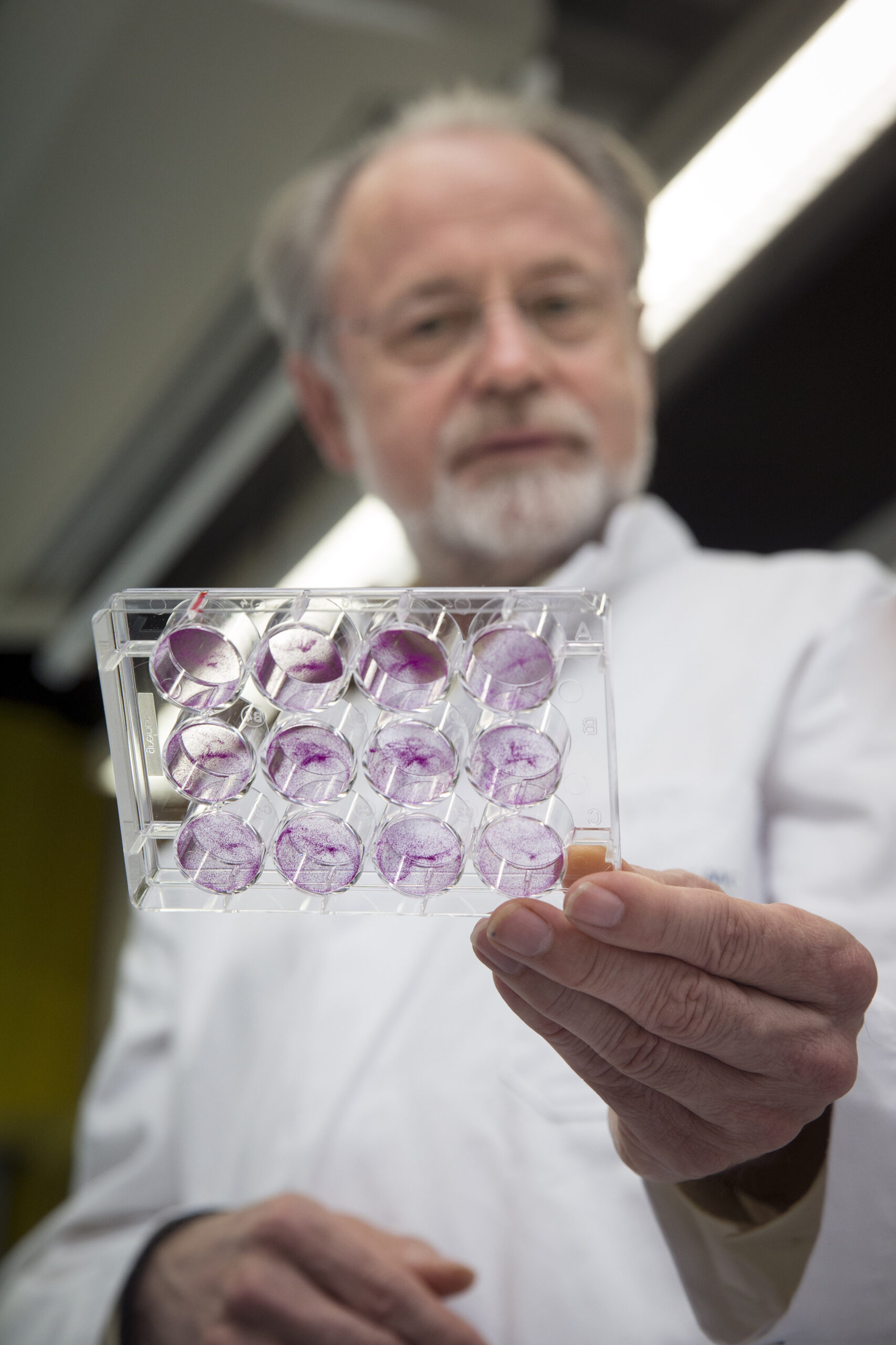 Onderzoeker met een schaaltje met gekweekte tumorcellen