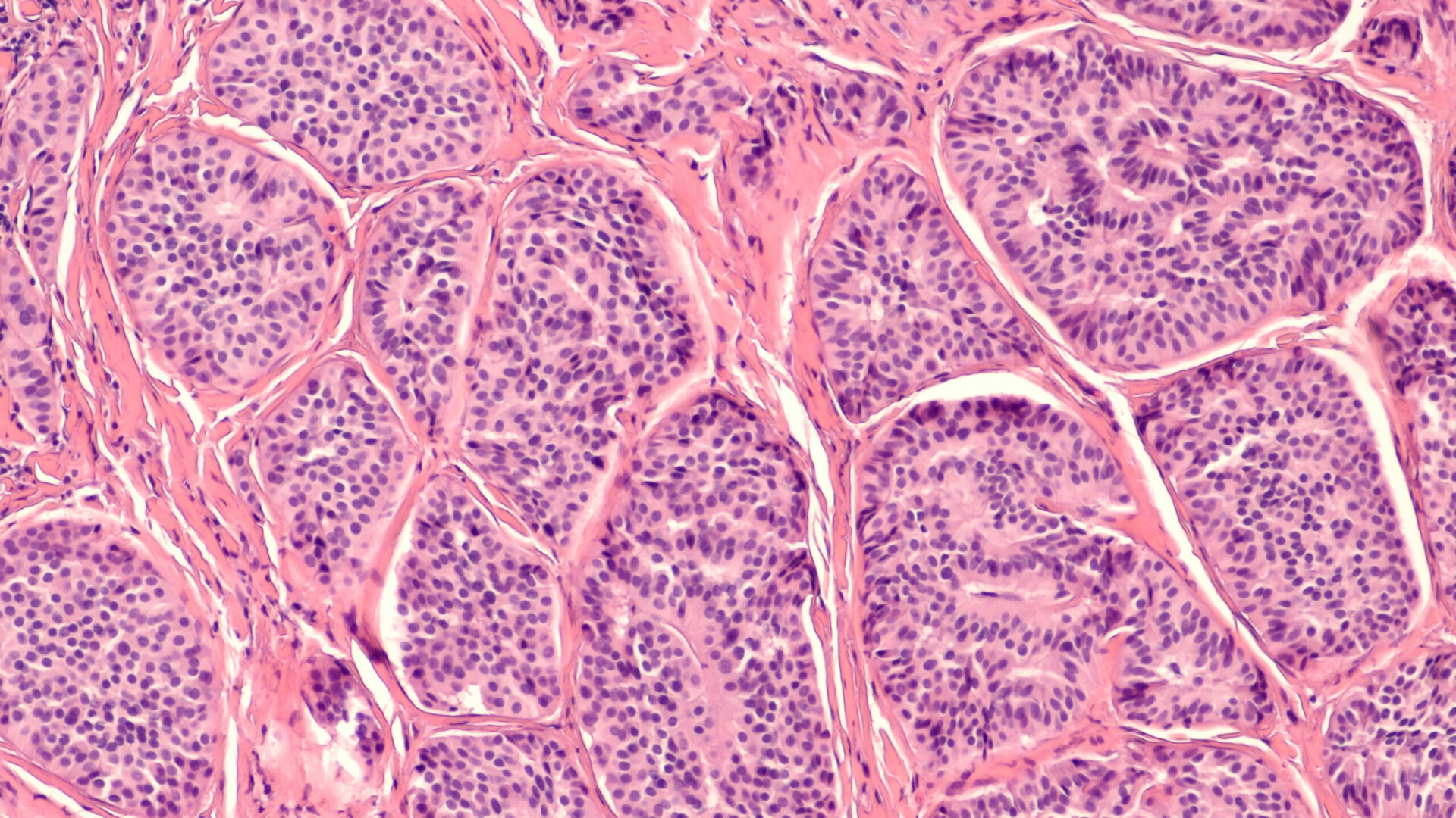 Photomicrograph,Of,A,Carcinoid,Tumor,,A,Type,Of,Neuroendocrine,Tumor