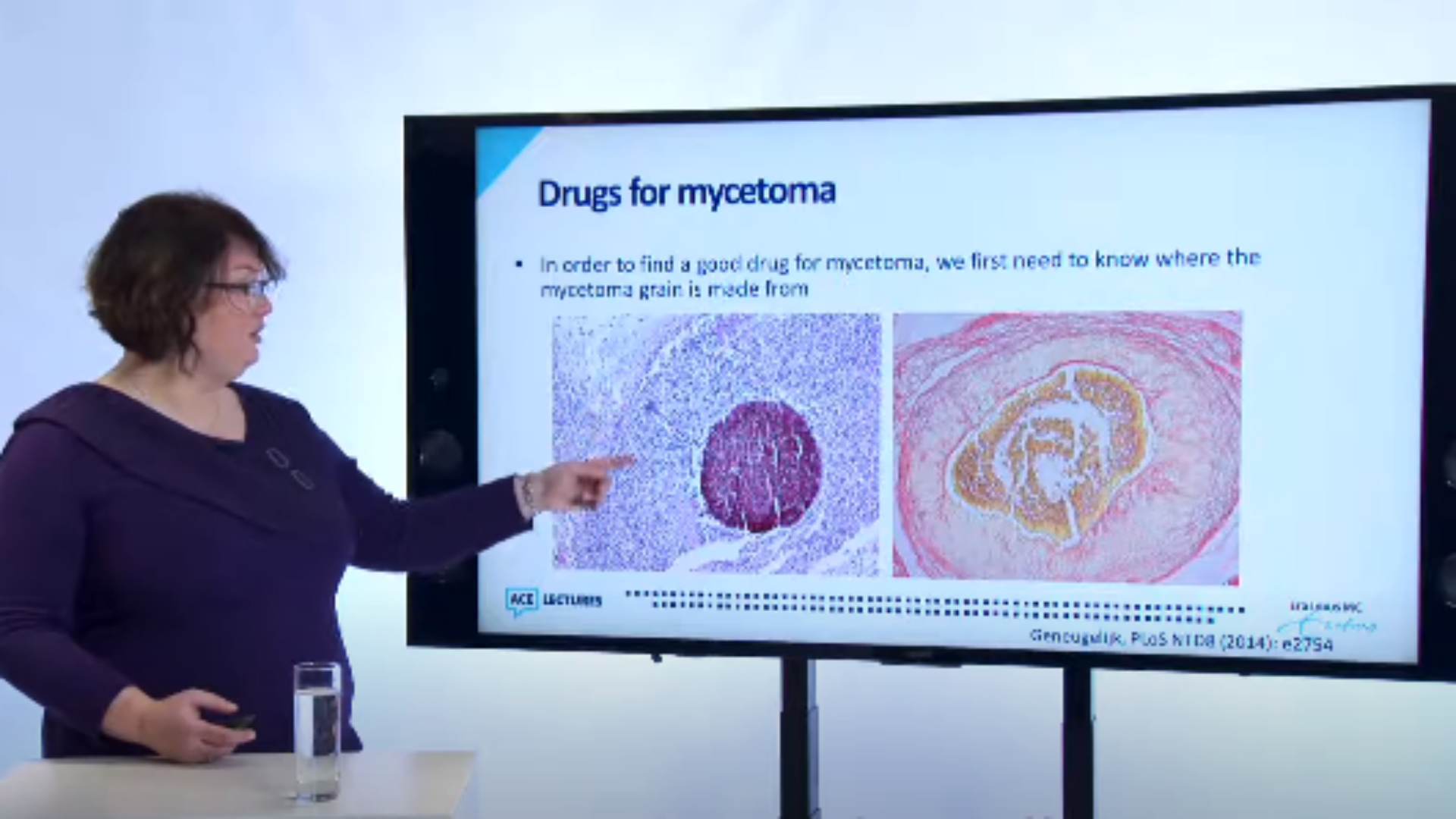 Wendy van de Sande zoekt een nieuw medicijn voor mycetoma.