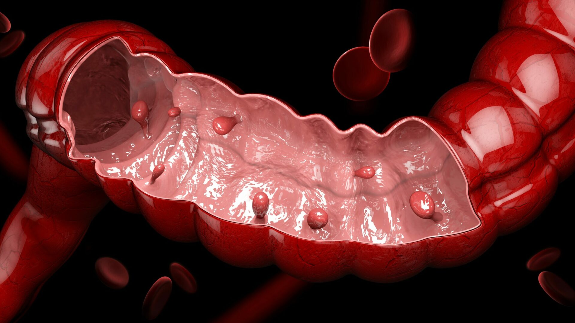 3d,Illustration,Of,Colon,Polyps.,Polyp,In,The,Intestine.,Isolated