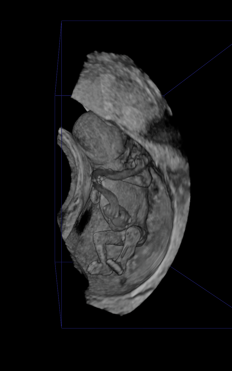 Foetus van 58mm, 11-12 weken.