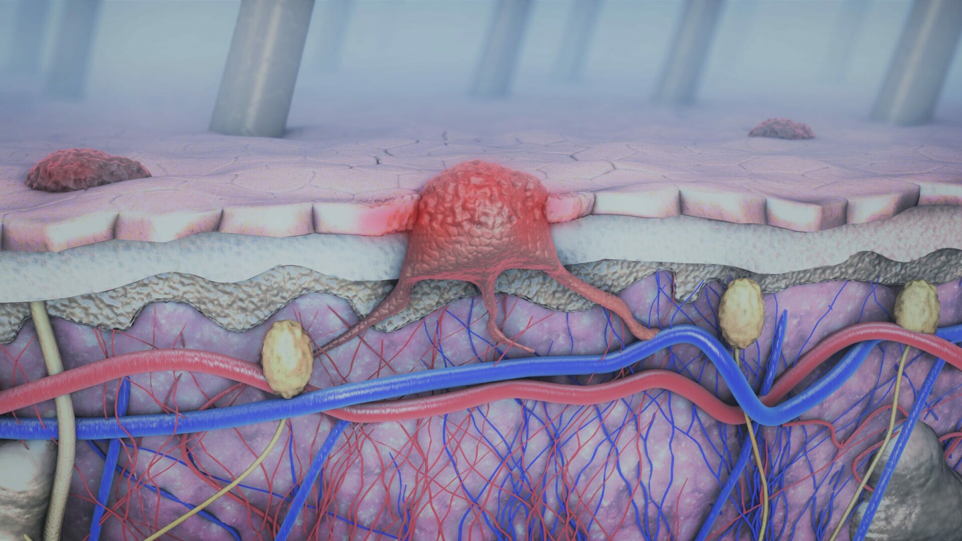 3d,Illustration,Of,A,Cross-section,Of,A,Diseased,Skin,With