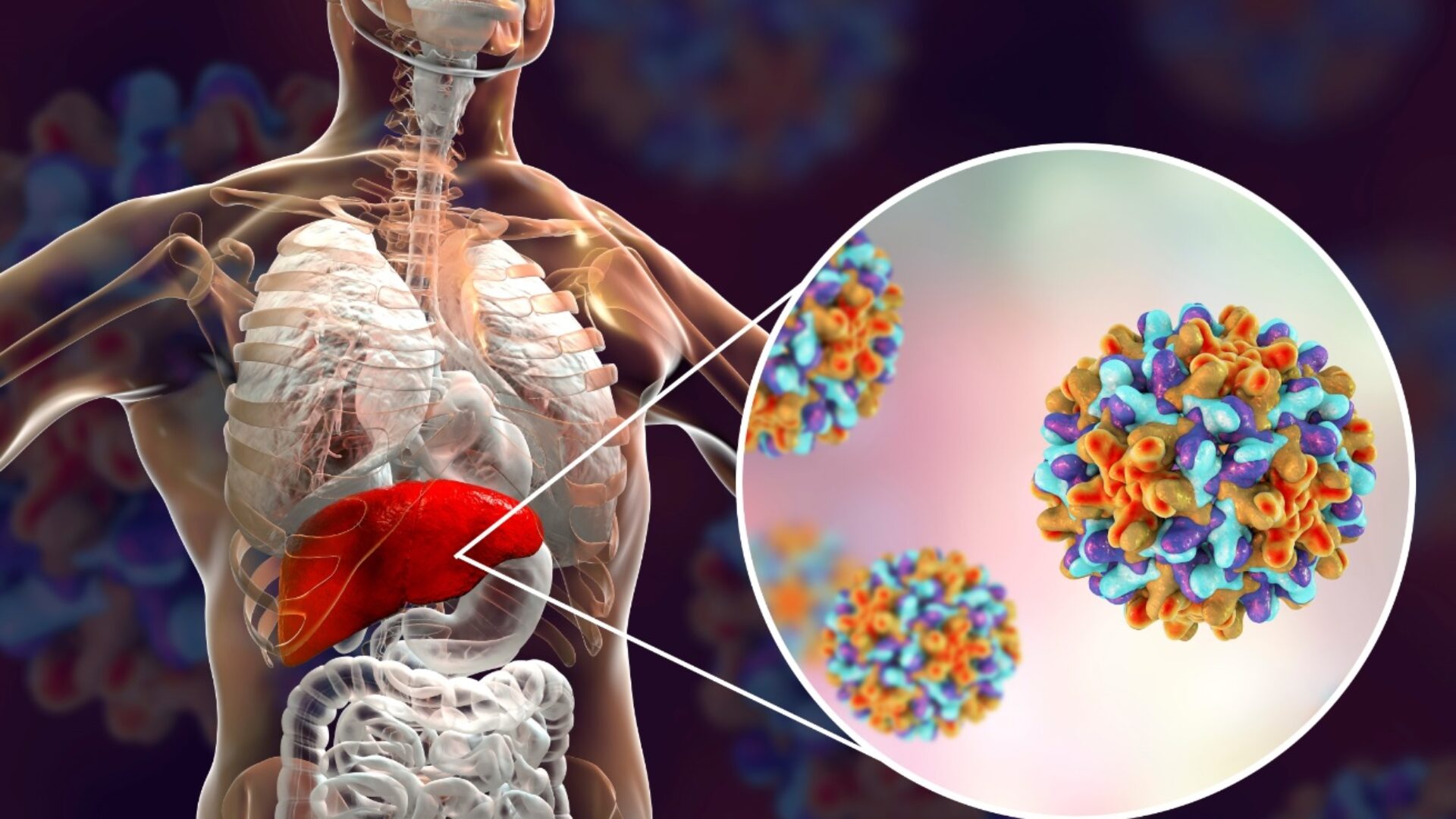Hepatitis B Milan Sonneveld klein