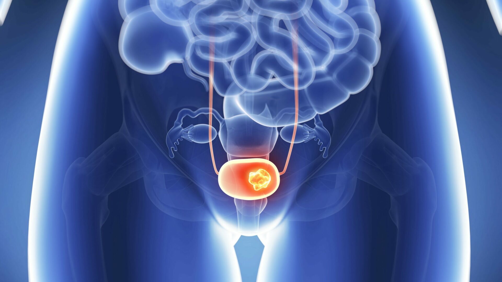 3d,Rendered,Illustration,-,Bladder,Cancer