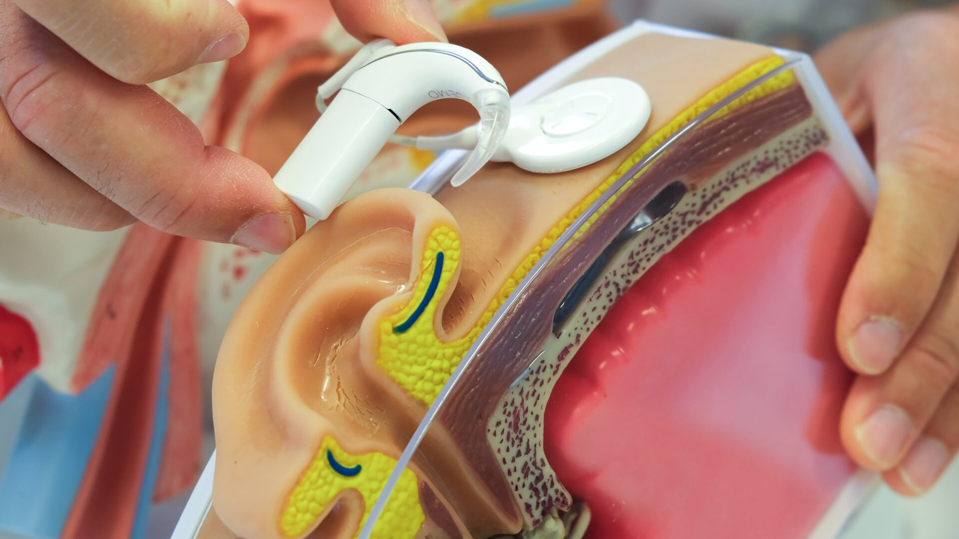 cochleair implantaat