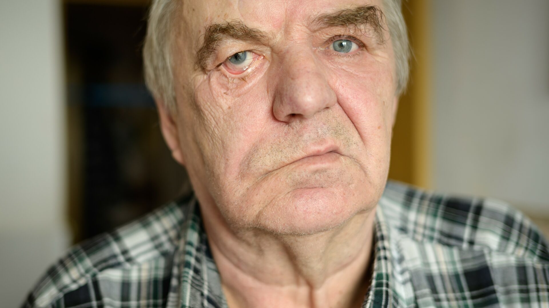 Aged,Man,With,Facial,Nerve,Paralysis,,Bell’s,Palsy.