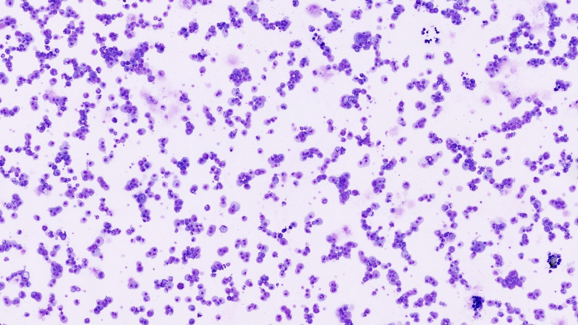 acute myeloide leukemie