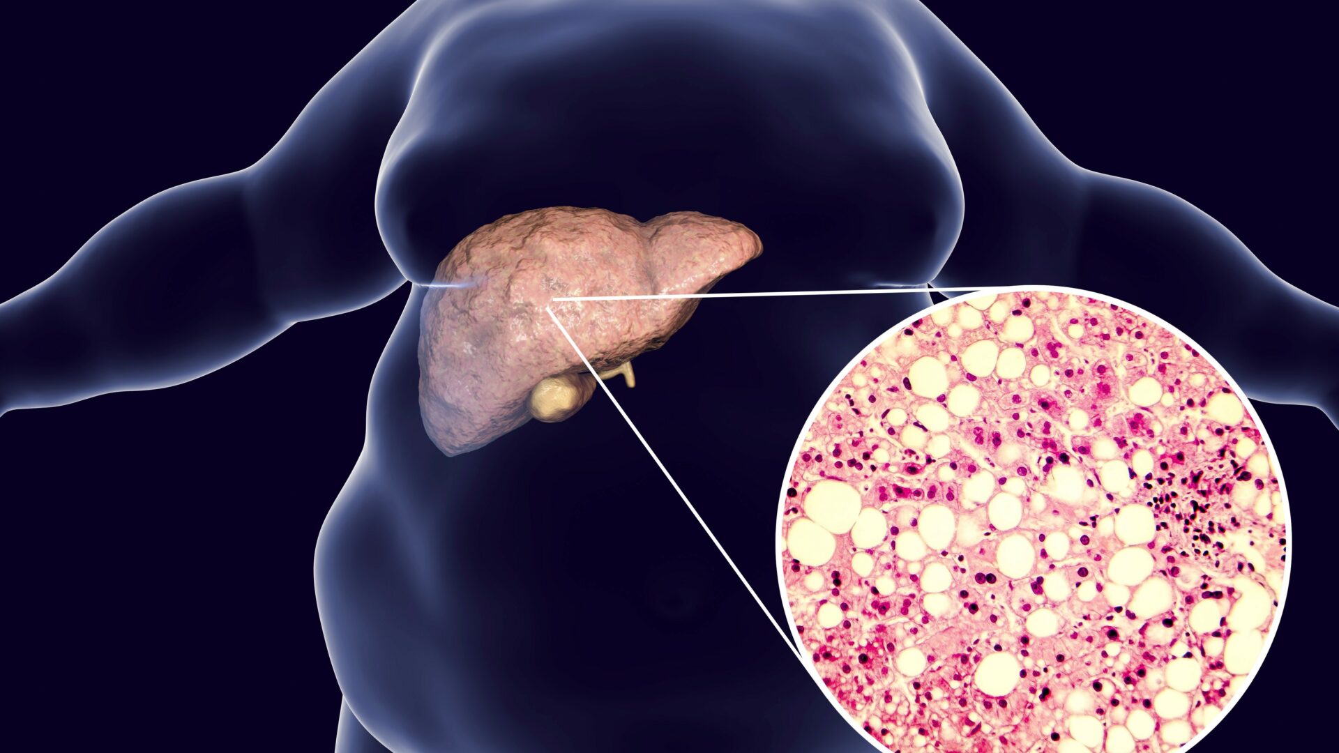 Obese,Man,With,Fatty,Liver,,3d,Illustration,And,Photomicrograph,Of