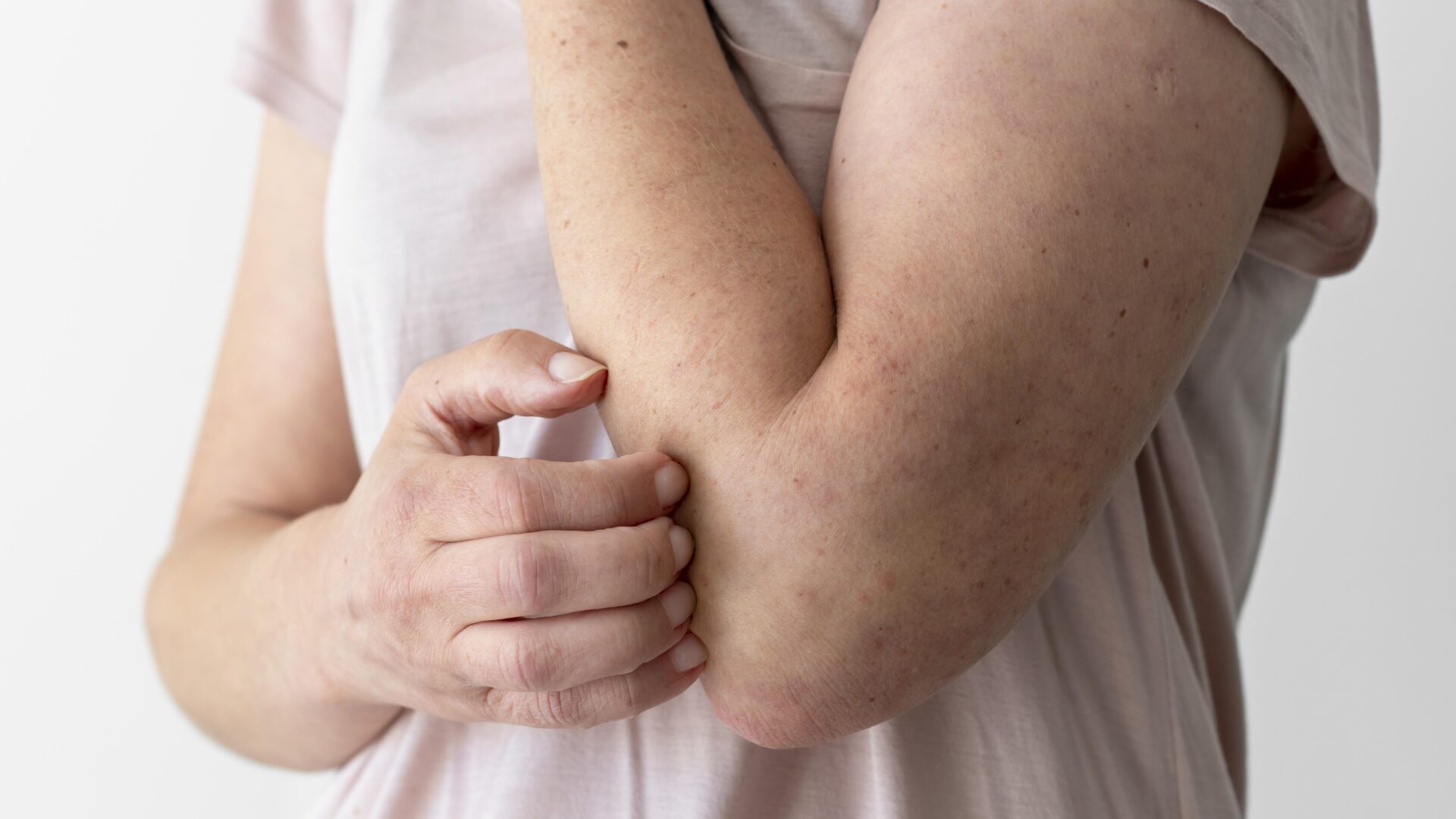 huidallergiereactie-op-de-arm-van-de-persoon (1)