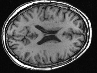 Biomarker may predict Parkinson’s disease progression